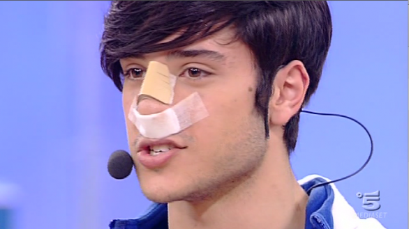 Amici, Giuseppe Giofrè con il naso spaccato