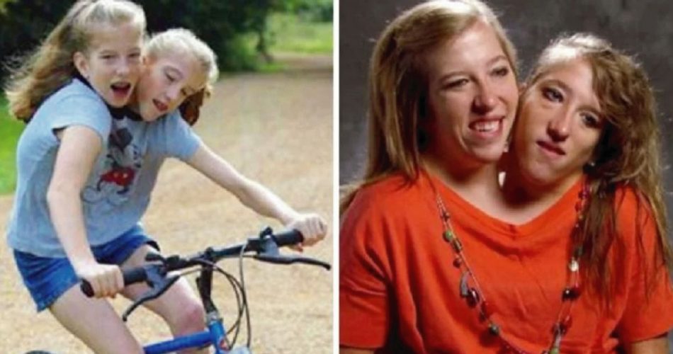 Gemelle Siamesi: prima e dopo, l’incredibile storia di Abby e Brittany Hensel